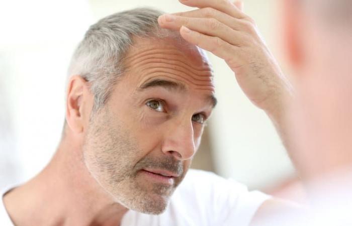 Dies sind die Behandlungen, die Ärzte empfehlen, um männlichen Haarausfall zu vermeiden