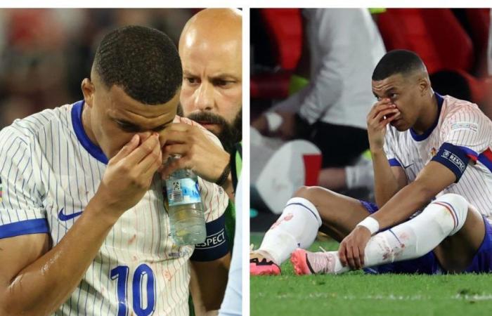 Kylian Mbappé muss sich laut französischer Presse nach einem schweren Schlag auf die Nase einer Operation unterziehen: Ist die Europameisterschaft in Gefahr?