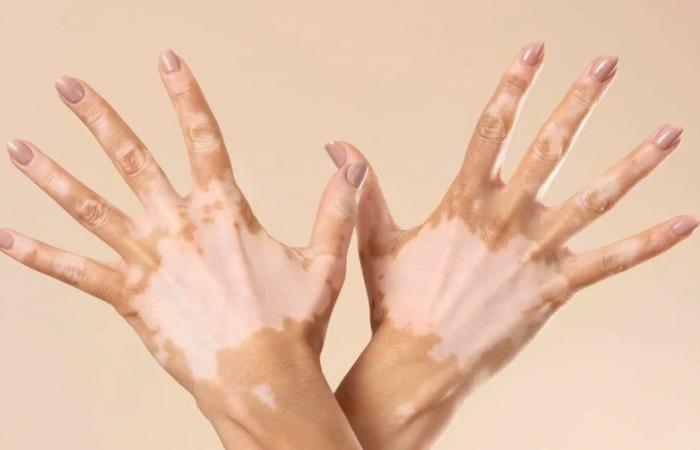 Welt-Vitiligo-Tag: Vier Schlüssel zu dieser Erkrankung, die sich auf die Hautpigmentierung auswirkt